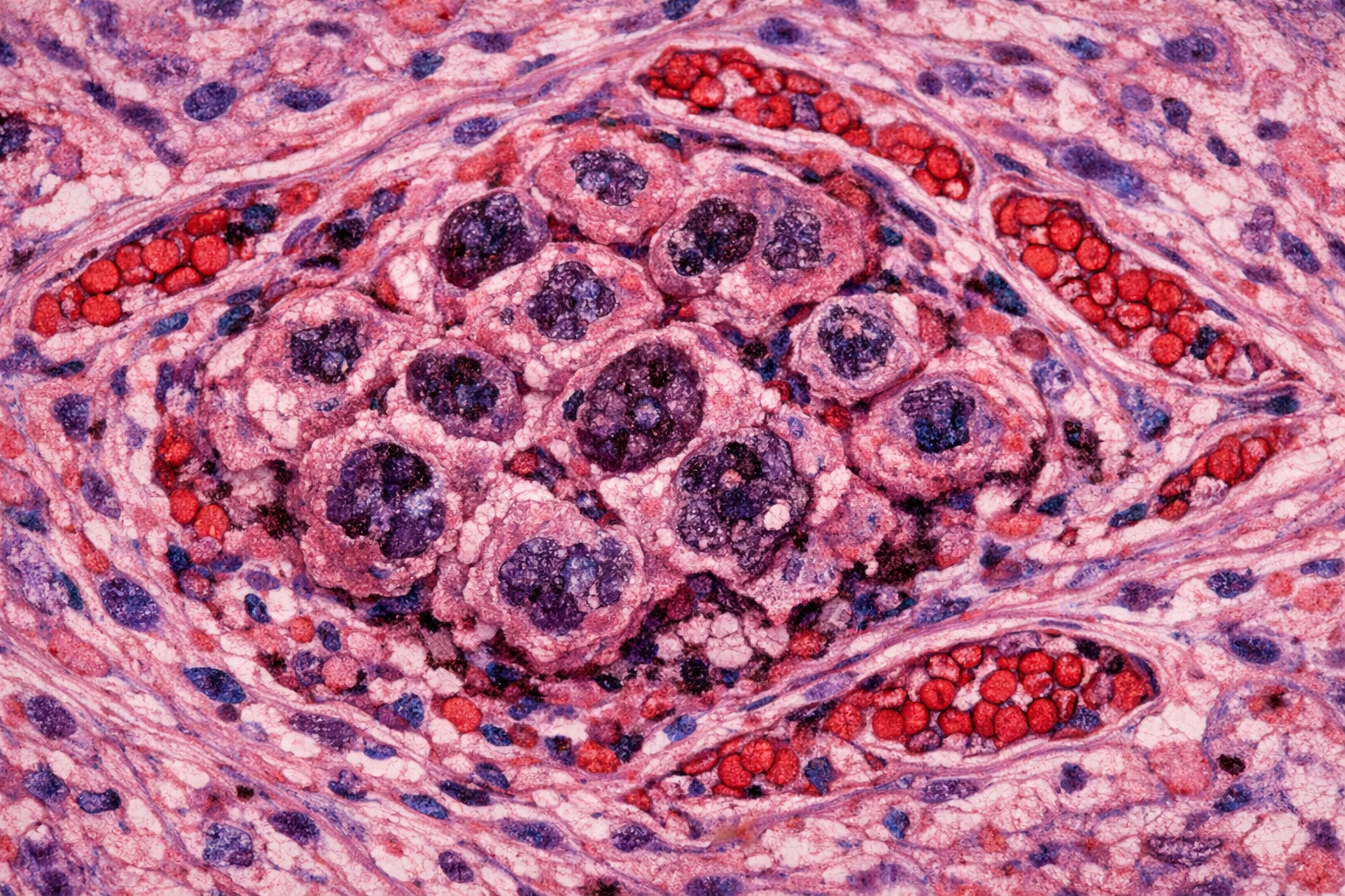 Human Liver Cancer-Associated Endothelial Squamous Cells